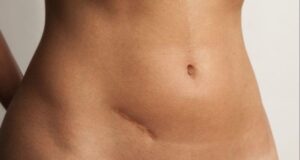 jazvy ako sa ich zbaviť