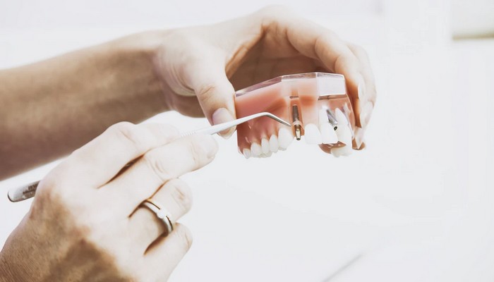 zubné implantáty