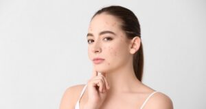 čo pozitívne vplýva na akné